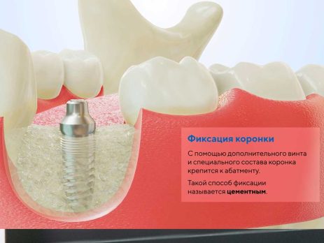 Восстановление зуба коронкой