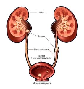 Камни в почках