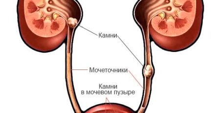 Камни в почках