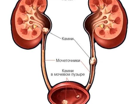 Камни в почках