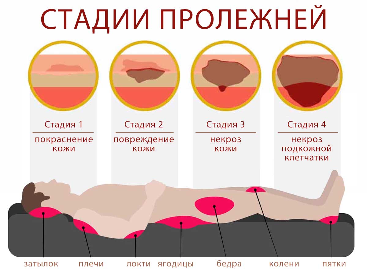 Места и стадии пролежней