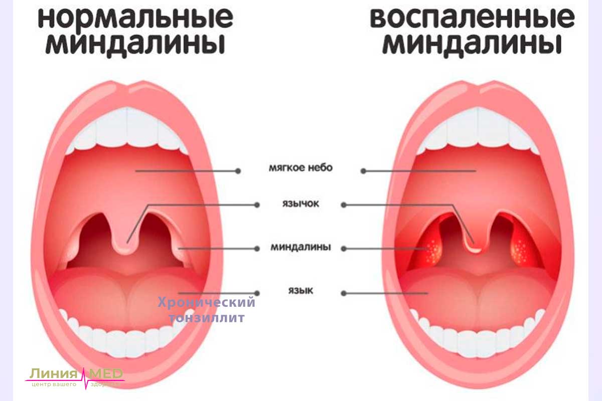 Промывание миндалин