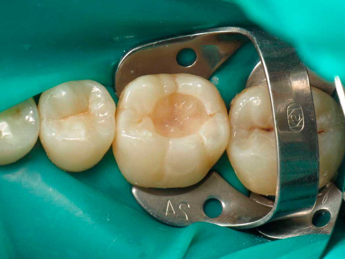Пломбировка зуба при использовании коффердама