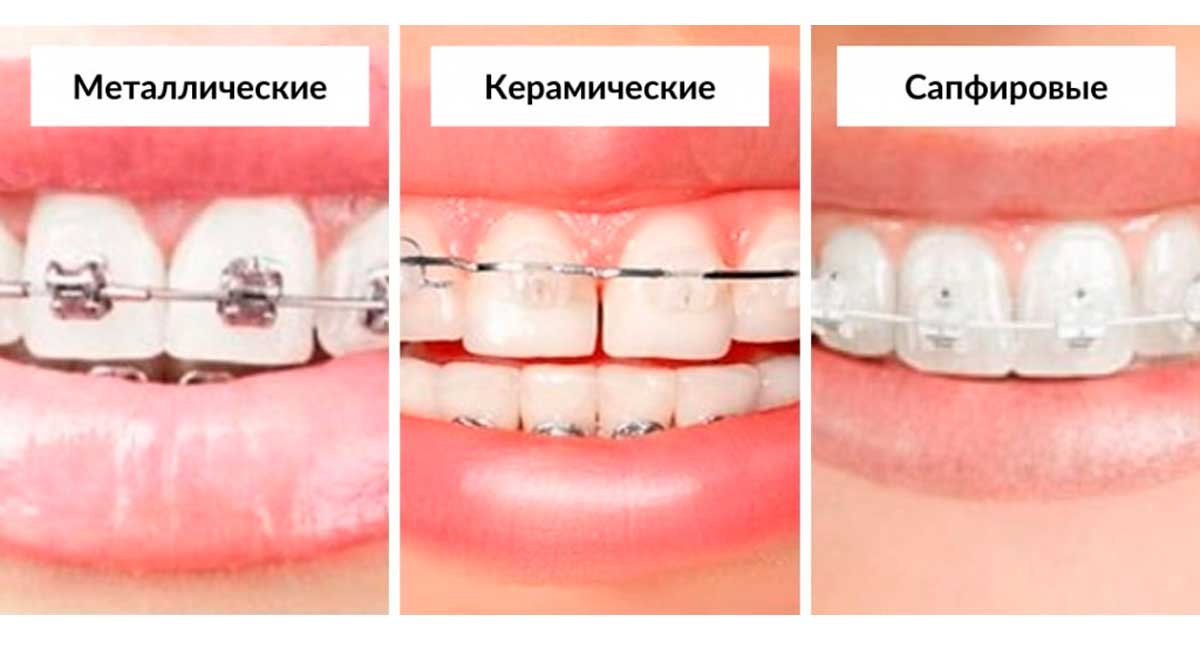 Металлические, керамические и сапфировые брекет-системы