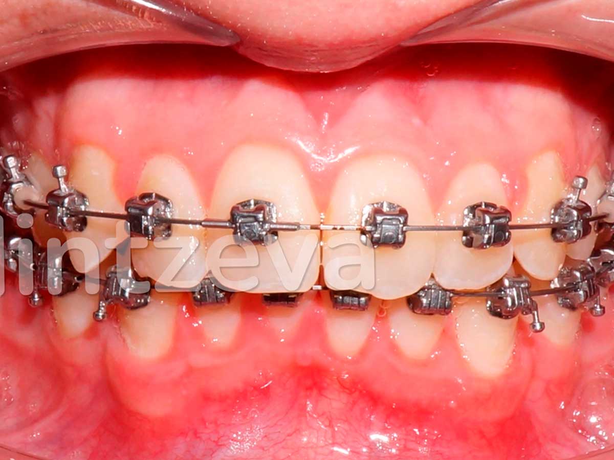 Вид зубов после коррекции брекетами