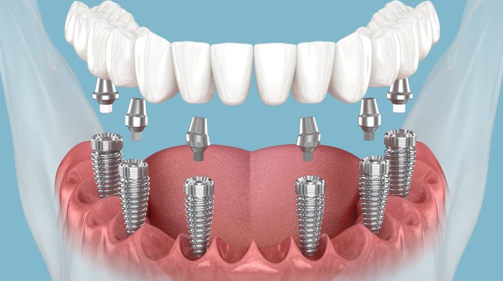 Имплантация All-on-6