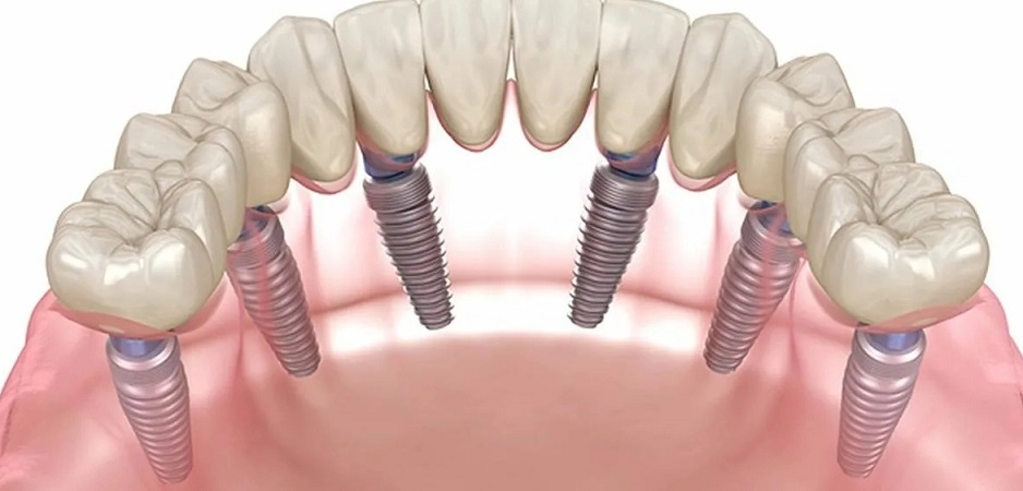 Что нужно сделать перед Имплантацией All-on-6